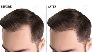 hair transplant in Pakistan
